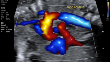 ECOCARDIOGRAFIA FETAL 